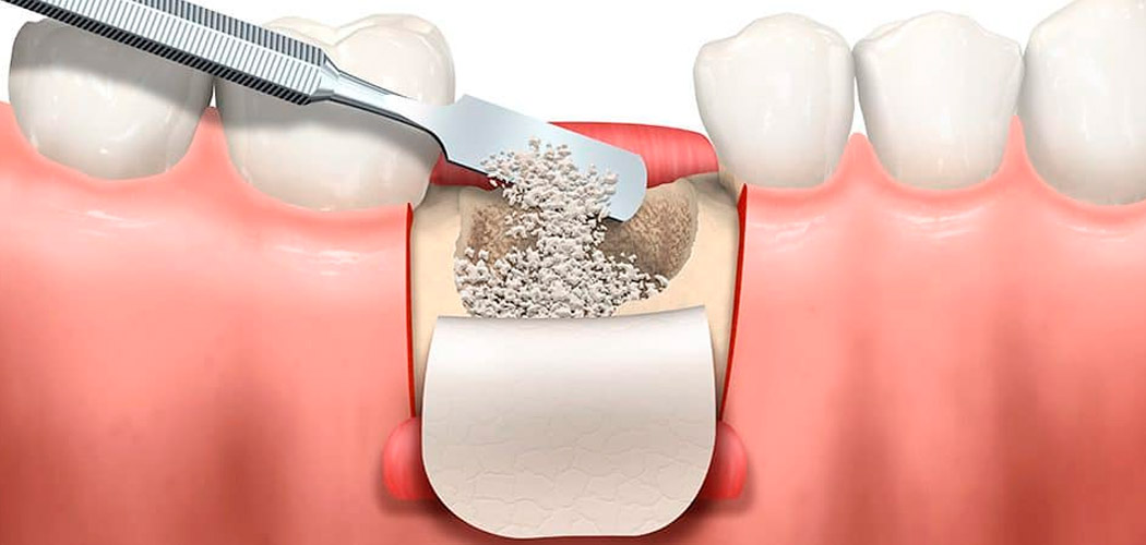 Enxerto Ósseo Dentário